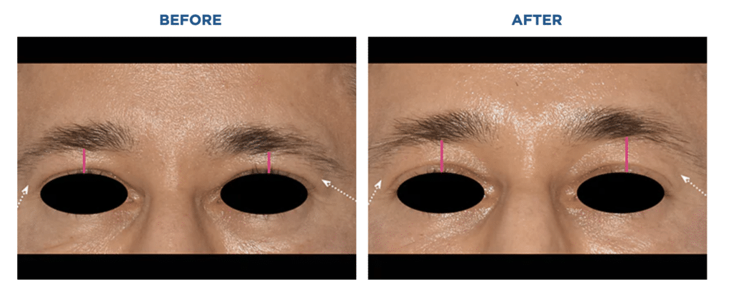 emface eyelid before and after san diego