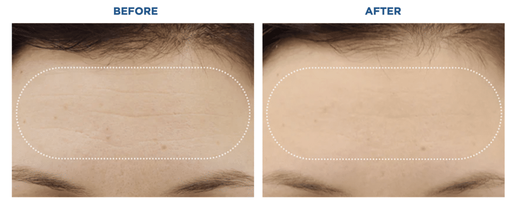emface forehead results art of skin md