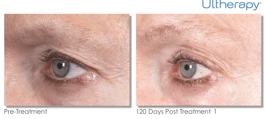Ultherapy Non-Surgical Facelift Brow Lift Art of Skin MD before and after