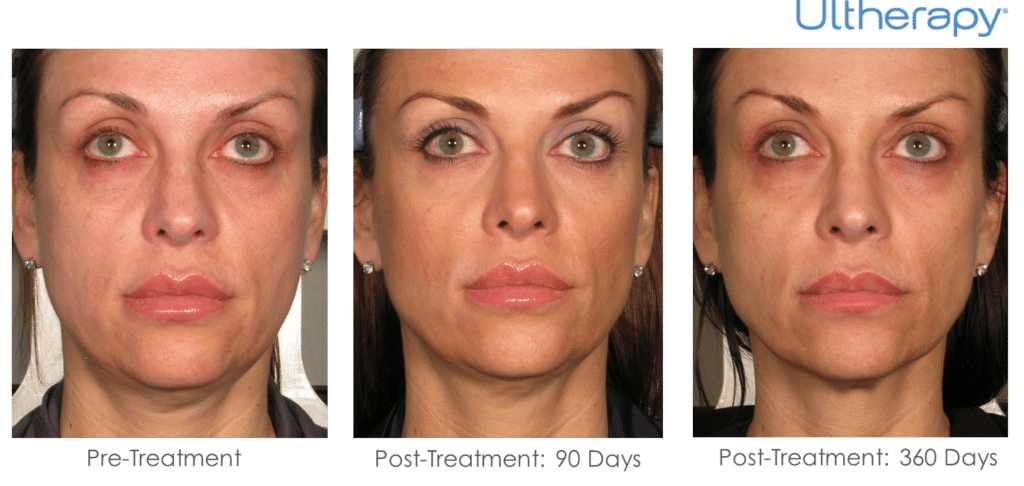 Ultherapy Non-Surgical Facelift Brow Lift Art of Skin MD before and after