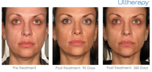 Ultherapy -Ultimate Non-Surgical Facelift -Brow Lift