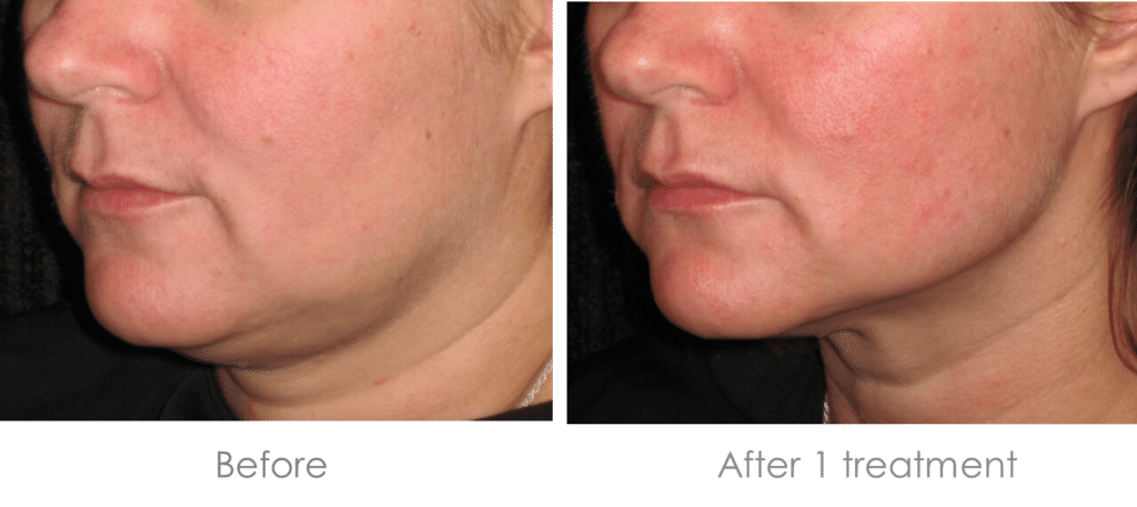 Ultherapy Non-Surgical Facelift Brow Lift Art of Skin MD before and after