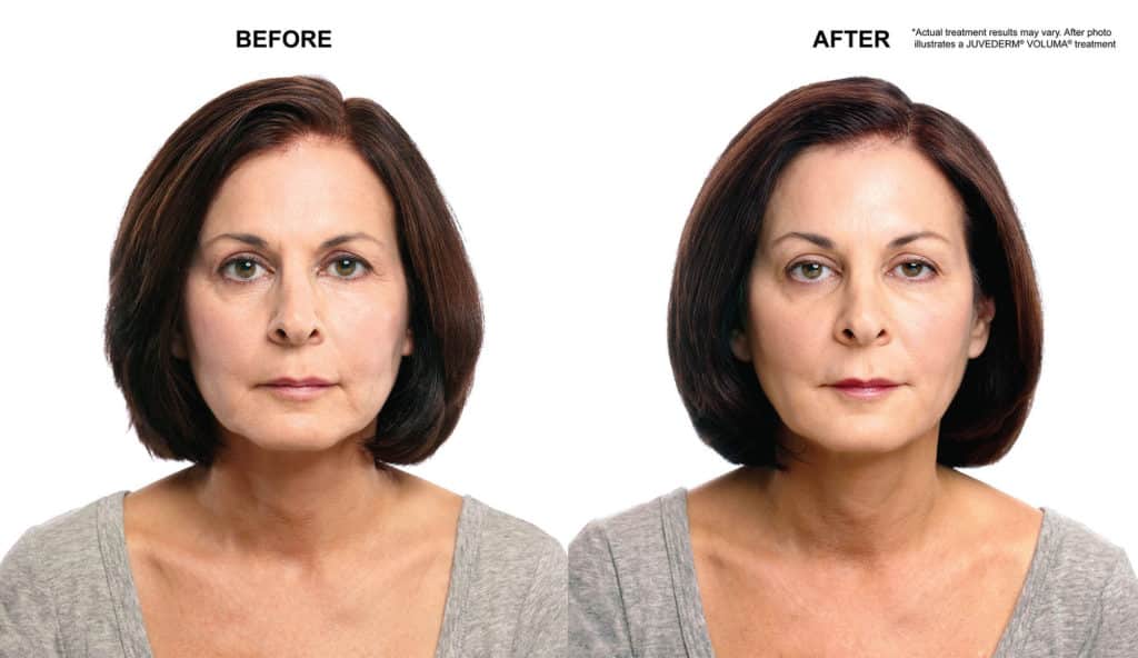 Voluma Juvederm XC FDA-Approved for Midface Volumizing --The Wait is Over San Diego