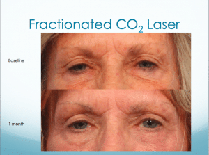 Fractionated CO2 Laser