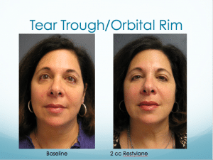 Tear Trough Treatment -Orbital Rim Treatment