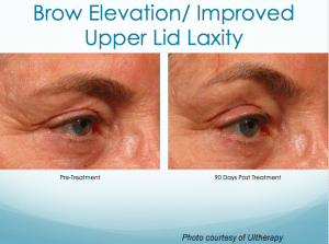 Brow Elevation -Improved Upper Lid Laxity