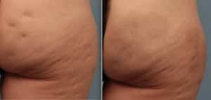 Cellulite Treatment San Diego -Cellfina Buttocks and Thigh