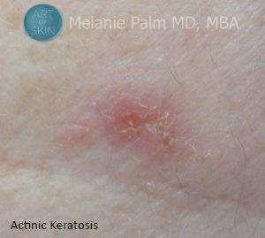 San Diego Skin Cancer Or Just A Mole -Actinic Keratosis