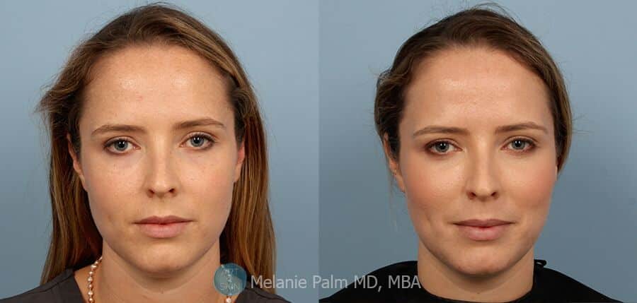 Under Eye Filler Dark Circles [ Before And After]