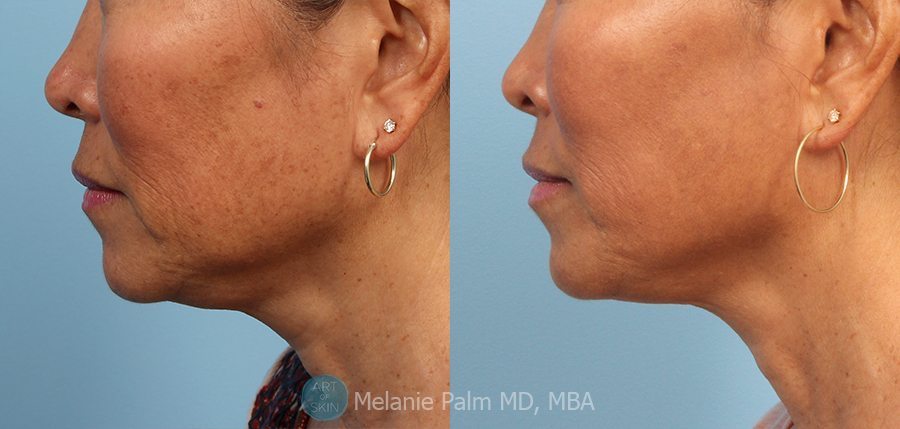Ultherapy Skin Tightening Made Comfortable For Patients