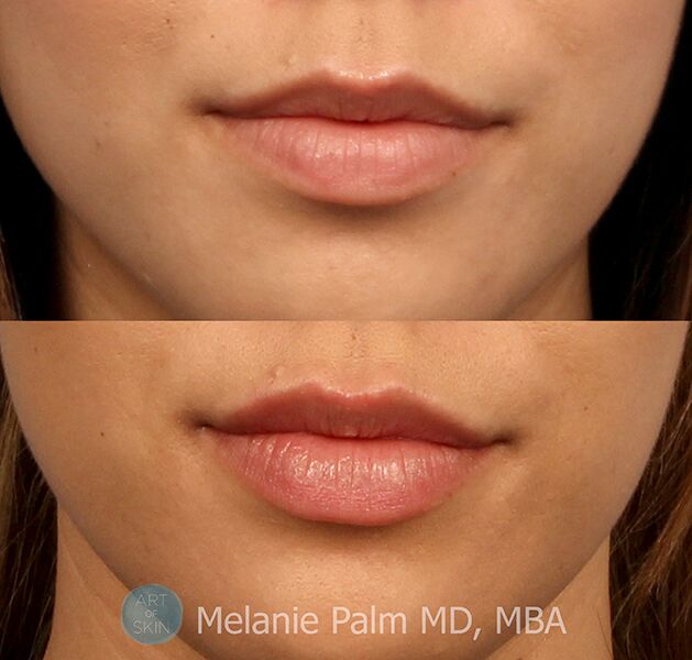 Lip Enhancement, Art of Skin MD