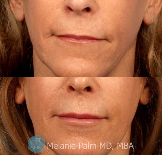 Vobella-lips-front-view, Art of Skin MD