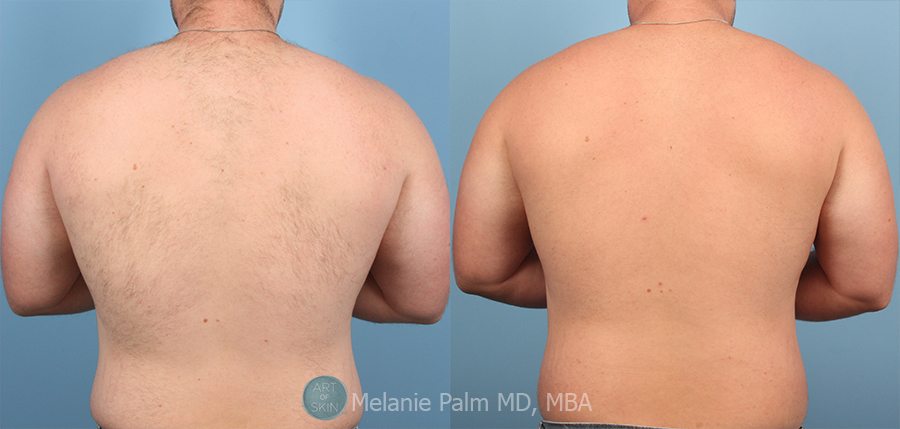 San Diego Laser Hair Removal Before and After Photos