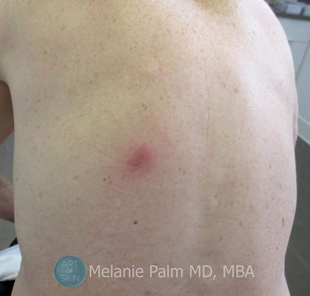 epidermoid cysts on back