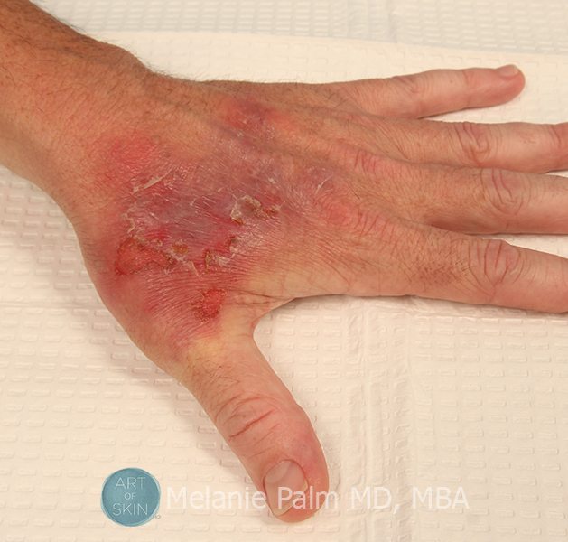 Contact Dermatitis, Art of Skin MD