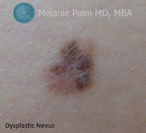 San Diego Skin Cancer Or Just A Mole -Dysplastic Nevus