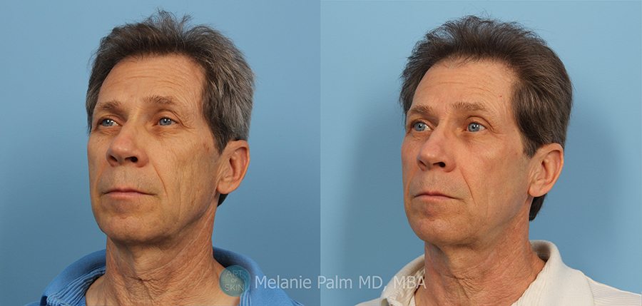 Laser Skin Tightening in San Diego, CA