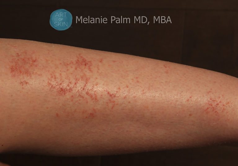 Eczema, Art of Skin MD