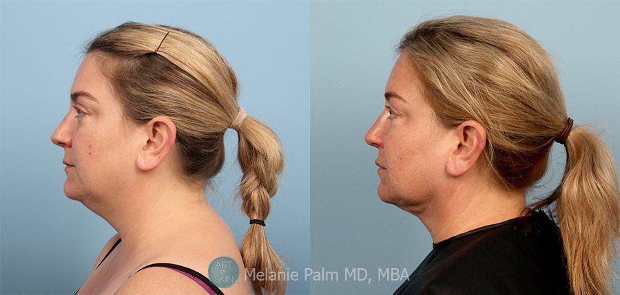 Double Chin, Jawline Definition, & Chin Enlargement, Art of Skin MD