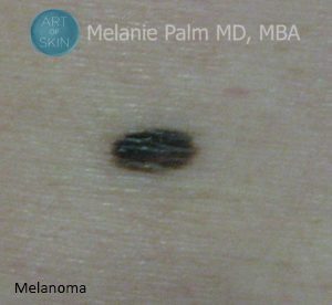 San Diego Skin Cancer Or Just A Mole -Melanoma