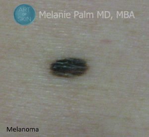 Moles and Melanoma, Art of Skin MD
