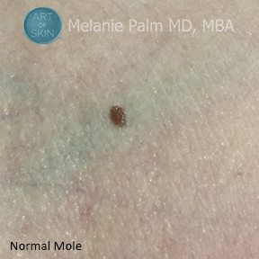 Normal Mole, Art of Skin MD