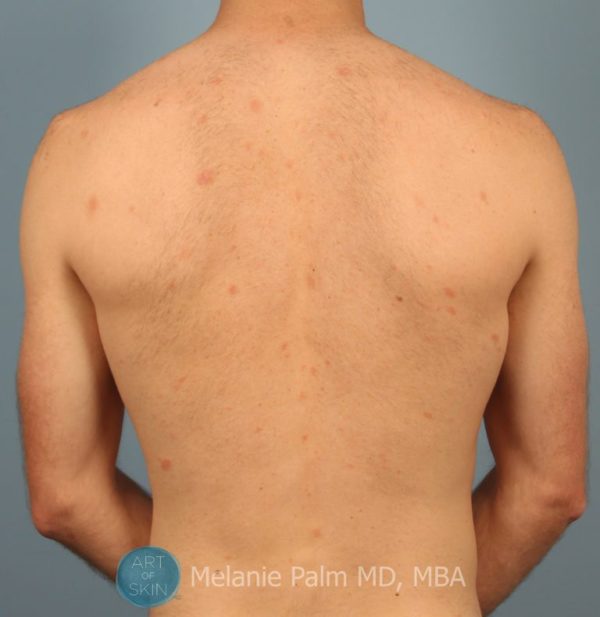 Pityriasis Rosea Treatment San Diego Christmas Tree Rash