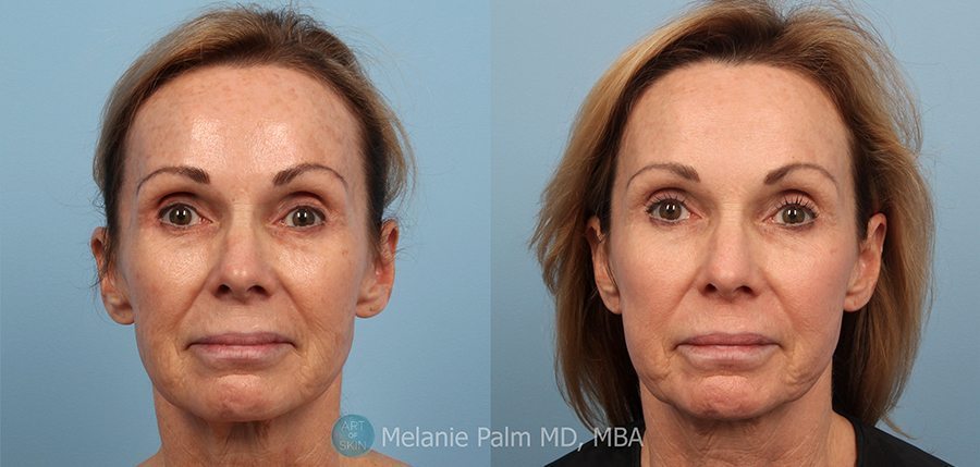 Photodynamic Therapy (PDT), Art of Skin MD