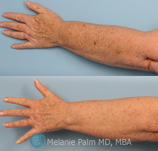 Photodynamic Therapy - Arms