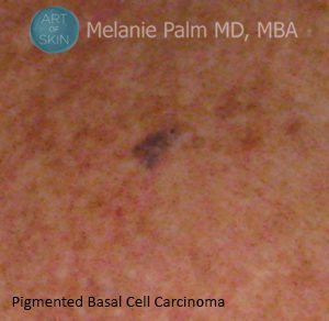 Pigmented Basal Cell Carcinoma, Art of Skin MD