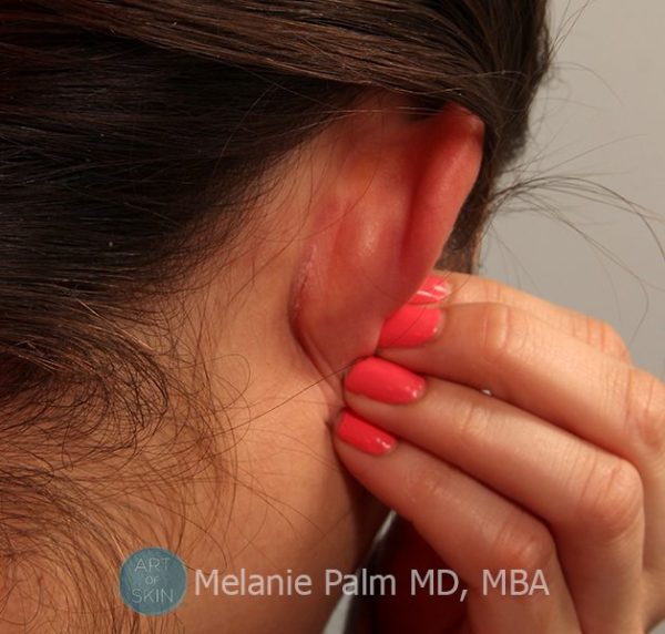 How to Treat Eczema -Understanding The Itch That Rashes