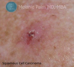 San Diego Skin Cancer Or Just A Mole -Squamous Cell Carcinoma