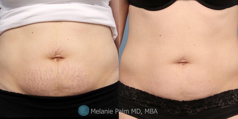 Stretchmarks Improved at Art of Skin MD