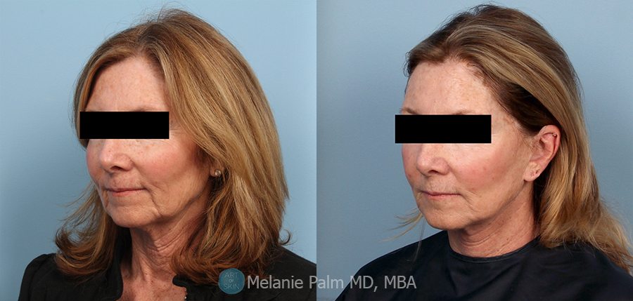 Ulthera Nonsurgical Face Lift, Art of Skin MD