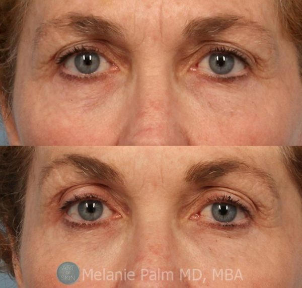 San Diego Eyelid and Brow Procedures Nonsurgical Brow Lift