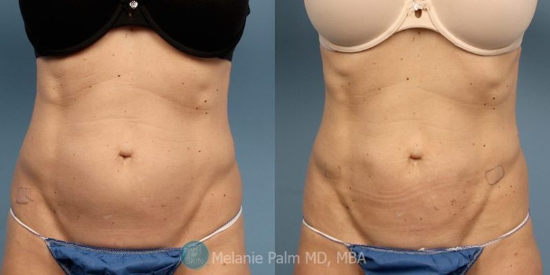 Body-Contouring-Abs-Accusculpt-San-Diego, Art of Skin MD