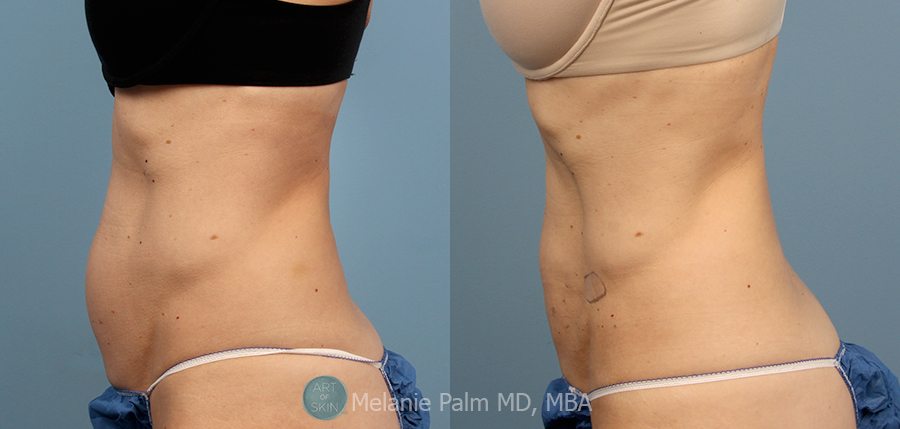 Laser Liposuction with Accusculpt Before After Photos