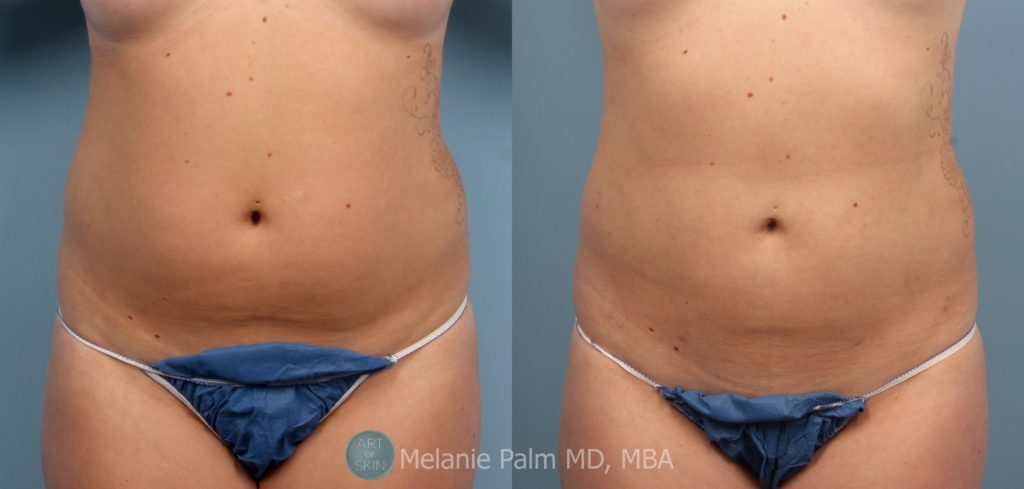 Body-Contouring-Abs-Lipo-San-Diego, Art of Skin MD