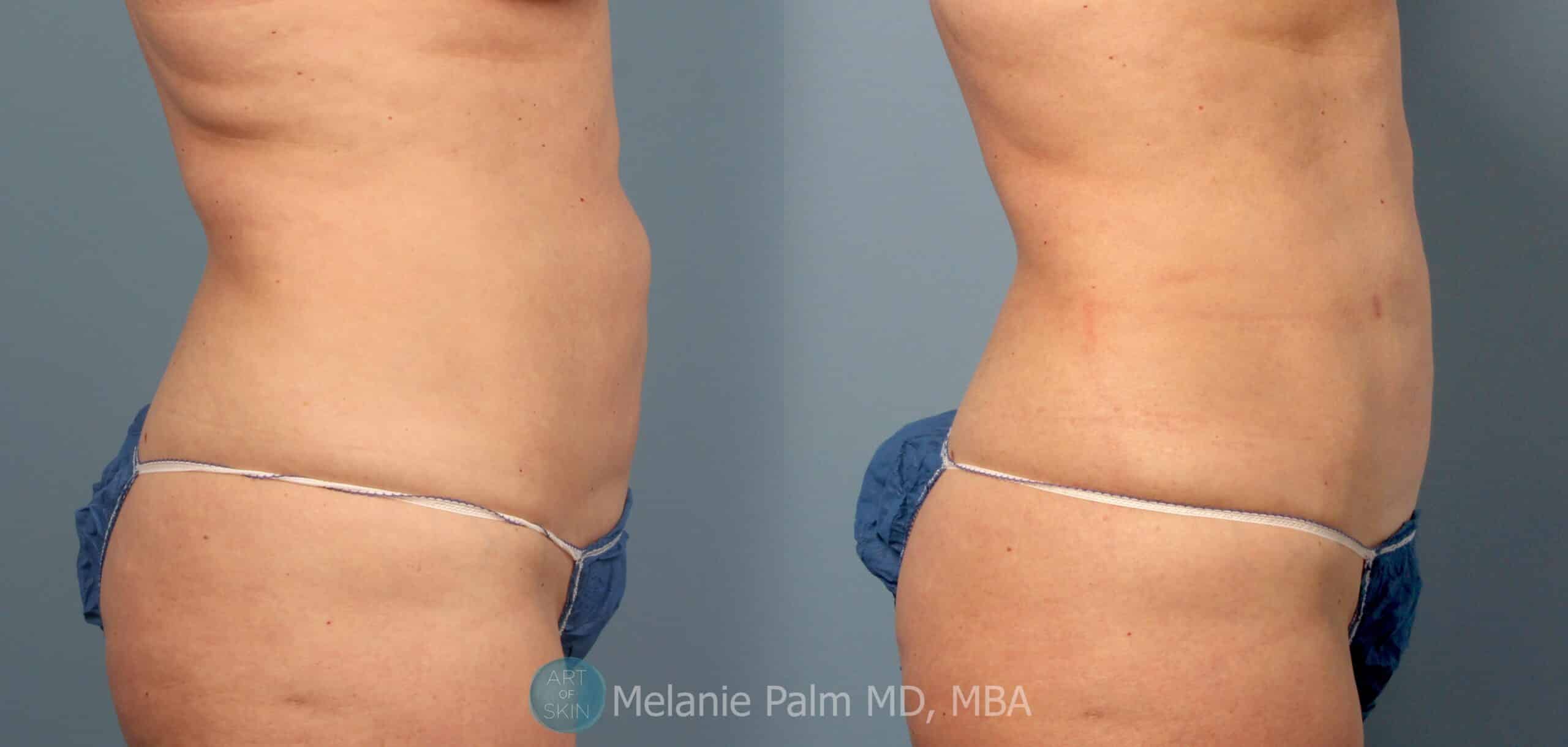 Liposculpture - Muffin Top Surgery Before and After Photos