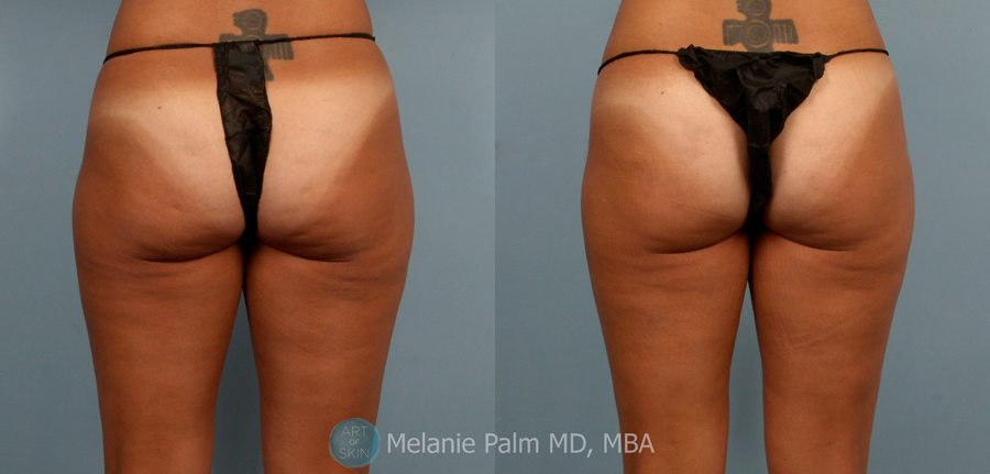 Body-Contouring-Cellfina-San-Diego, Art of Skin MD