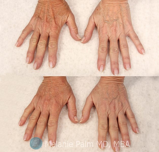 Hand Rejuvenation, Art of Skin MD