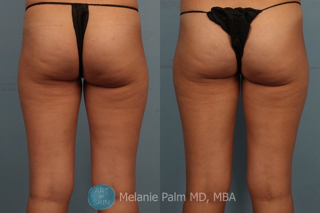 Cellutone Cellulite Treatment, Art of Skin MD