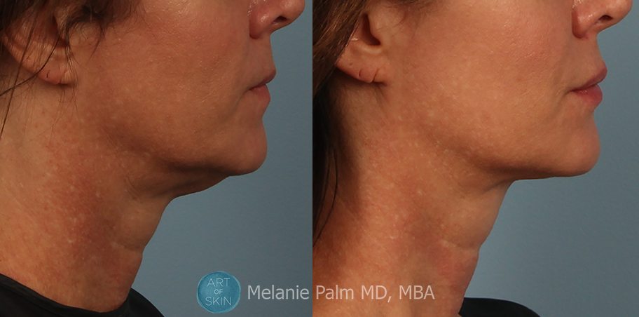 Kybella Injectable Fat Reduction, Art of Skin MD