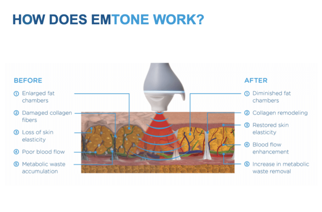 how emtone works