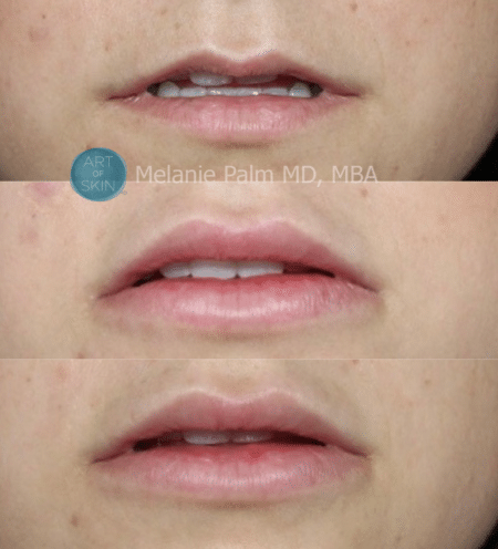 Restylane Kysse lips before and after Dr. Palm