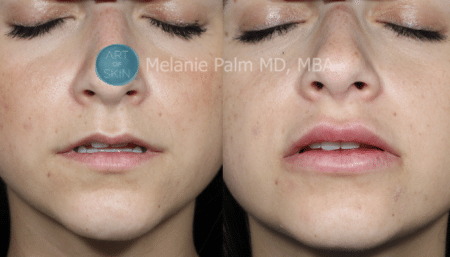Restylane Kysse lips before and after