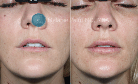 Restylane Kysse lips before and after