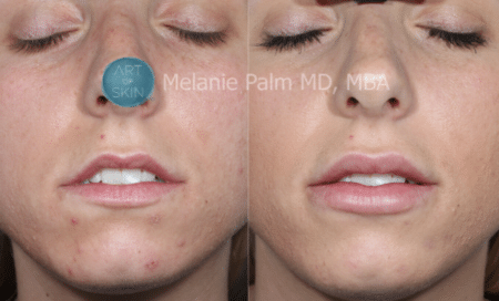 Restylane Kysse lips before and after photos