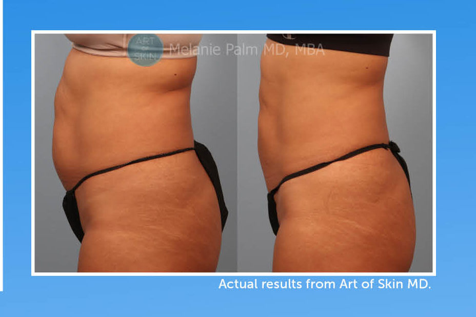 Art Of Skin MD - June 2020 coolsculpting san diego