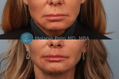 Restylane Kysse before and after art of skin md